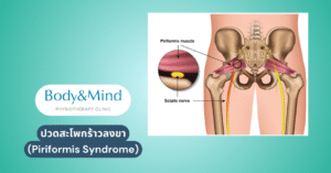 ปวดสะโพกร้าวลงขา (Piriformis Syndrome)