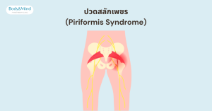 ปวดสลักเพชร (Piriformis Syndrome)